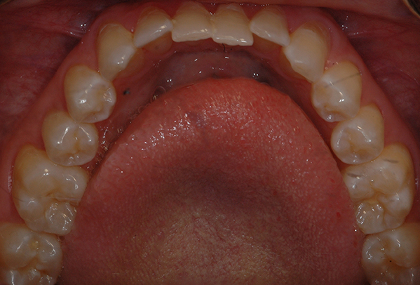 Mouth/teeth before Inman Aligners