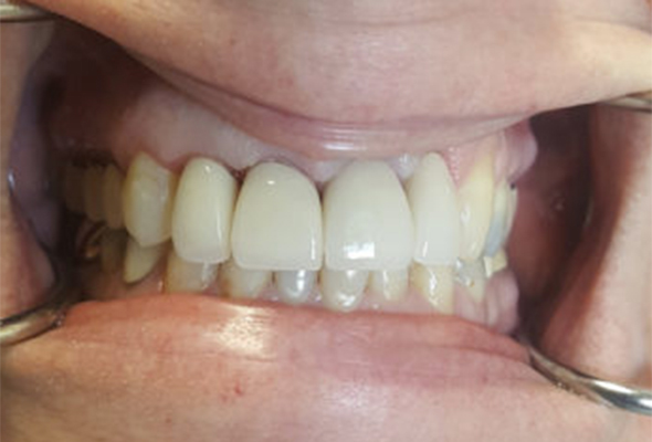 Mouth/teeth after dental treatment