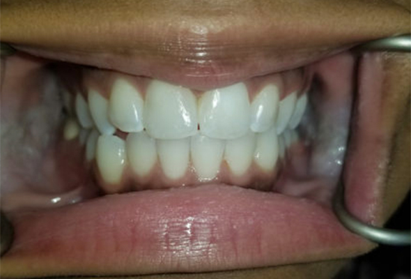 Mouth/teeth after dental treatment