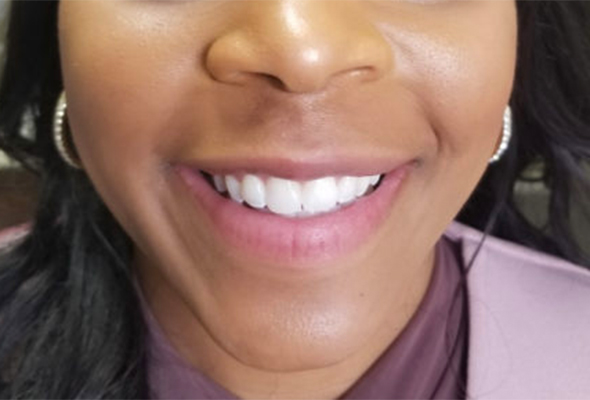 Lower half of face with focus on mouth/teeth after dental treatment